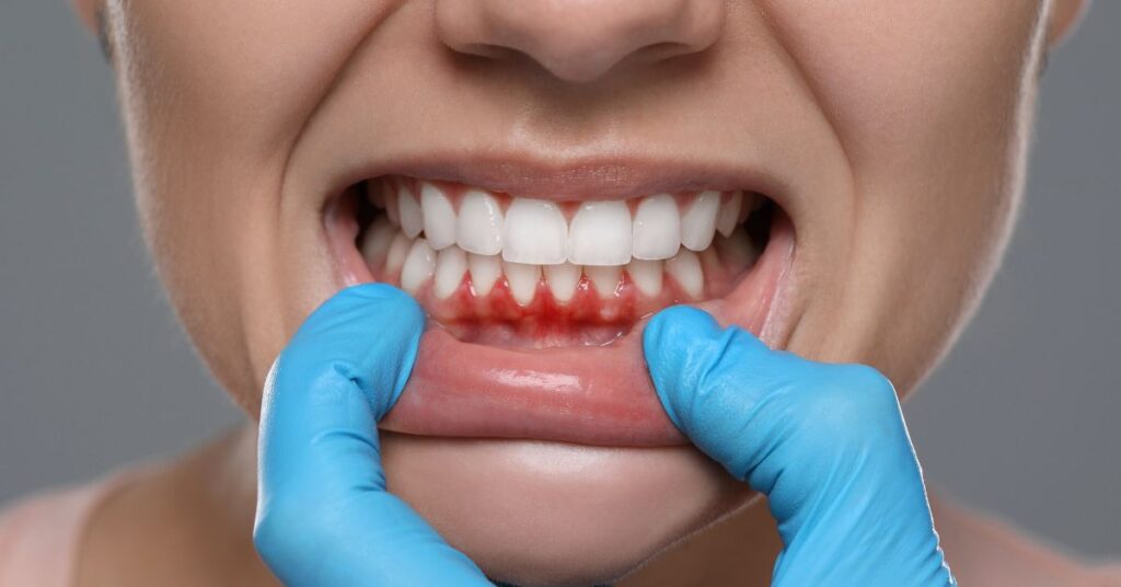 How Lasers Treat Gum Disease