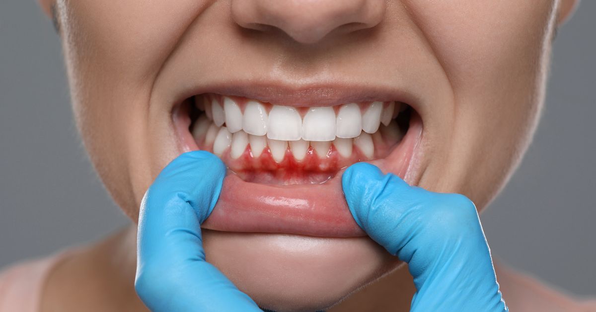 How Lasers Treat Gum Disease