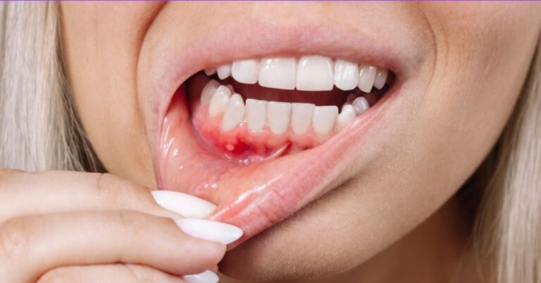 early signs of gum disease