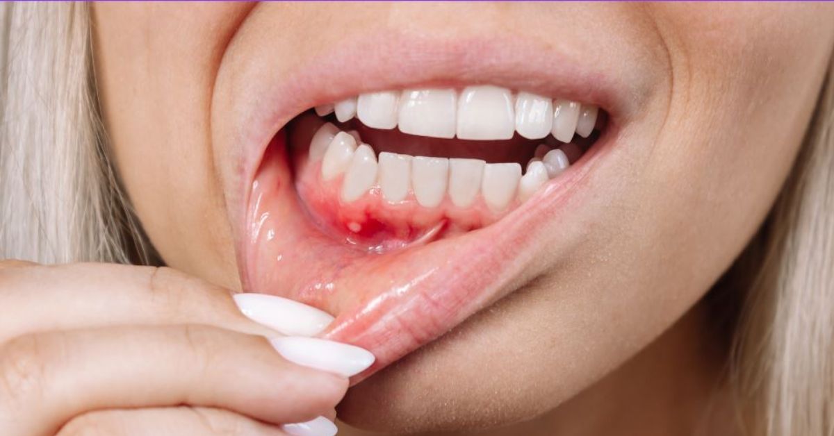 early signs of gum disease