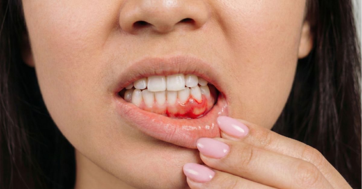 signs of gum disease