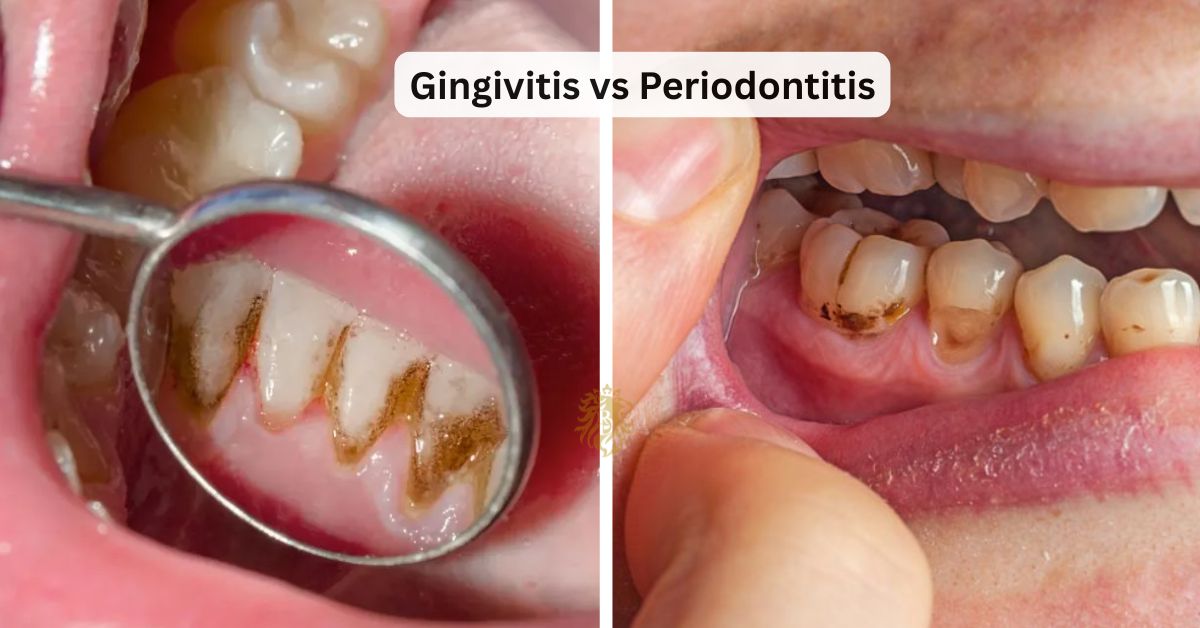 do i have gum disease